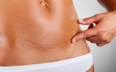C-Section Recovery: Specialized Postpartum Care