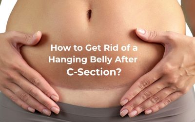 C-Section Scar Care: 4 Essential Tips | Postnatal Care of Mother